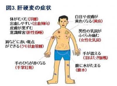図3.肝硬変の症状
