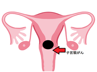 子宮頚部円錐切除術の画像