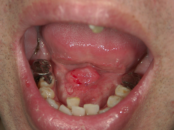 写真（4）口腔底がん