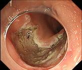 大腸がんの画像5